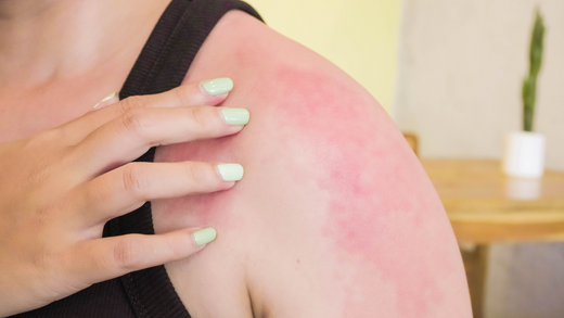 Soaking a Burn in Cold Water: Benefits and Best Practices with Renu Therapy Plunge Tanks